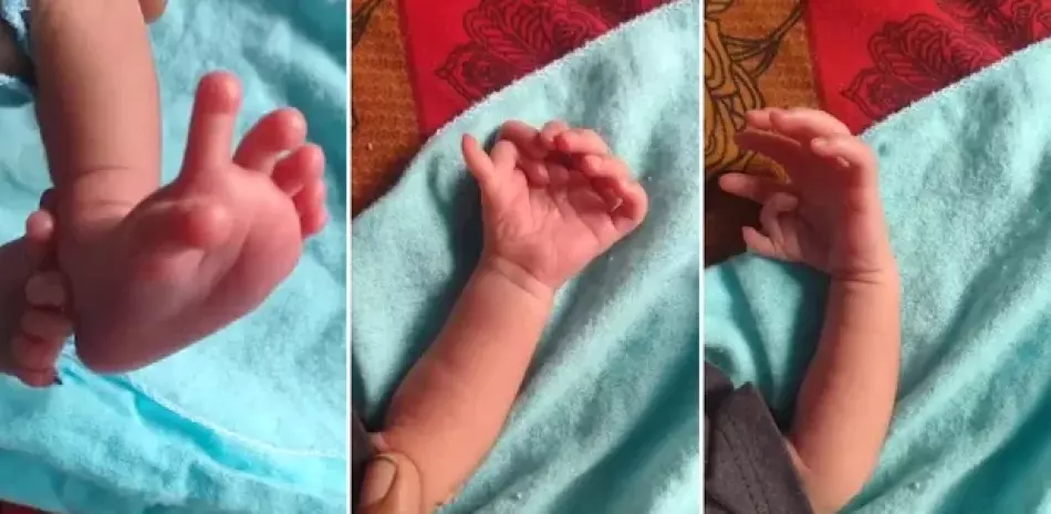 Nace una bebe con 26 dedos en el Norte de India; padres creen que es la reencarnación de una Diosa